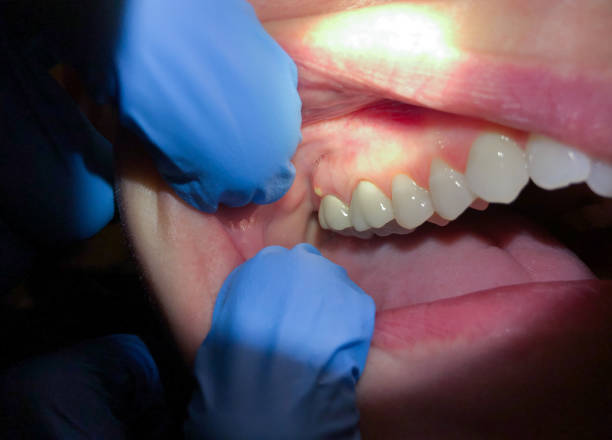 Best Teeth Whitening  in Woodall, OK